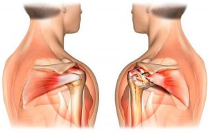 SLAP – синдром плечевого сустава