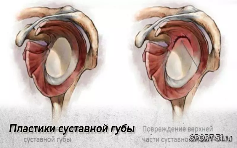 Плечевая губа суставная разрыв. Разрыв суставной губы гленоида плечевого сустава. Суставная губа гленоида плечевого сустава. Слэп повреждение плечевого сустава. Суставная губа гленоида лопатки.