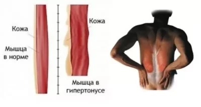 Исследование мышечного тонуса