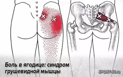 Боль в ягодицу: синдром грушевидной мышцы