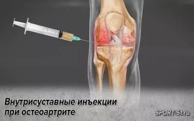 Внутрисуставные инъекции кортикостероидов при остеоартрите коленного сустава