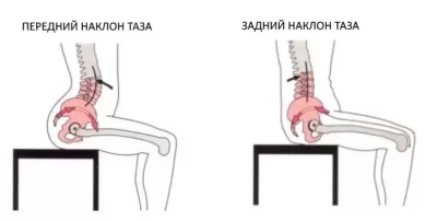 Гиперлордоз или передний наклон таза