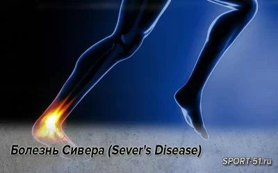 Болезнь Сивера (Sever's Disease)