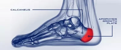 Болезнь Сивера (Sever's Disease)