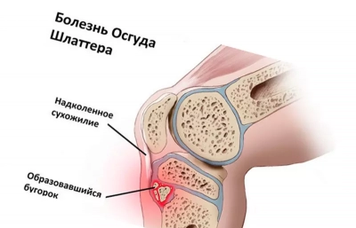 Болезнь шляттера у футболистов