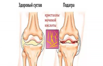 Болезнь Пеллегрини — Штиды