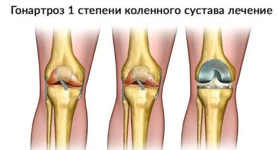 Болезнь Пеллегрини — Штиды