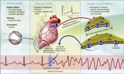 Commotio Cordis (сотрясение сердца)