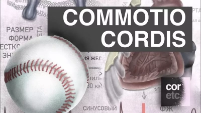 Commotio Cordis (сотрясение сердца)