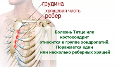 Синдром Титце