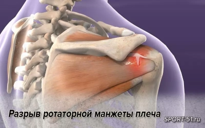 Разрыв ротаторной манжеты плеча