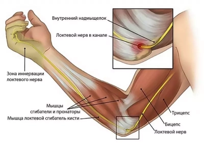 Локтевой туннельный синдром