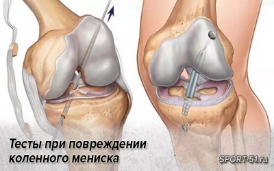 Тесты при повреждении коленного мениска