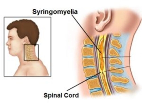 Сирингомиелия фото людей