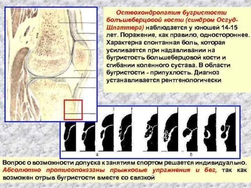 Остеохондропатии