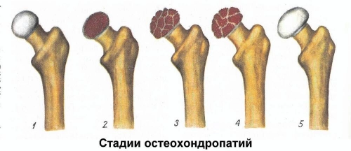 Остеохондропатии