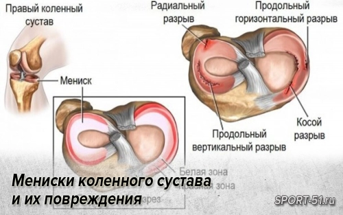 Мениски коленного сустава и их повреждения
