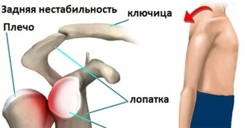 Нестабильность плечевого сустава