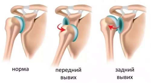 Нестабильность плечевого сустава