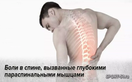 Боли в спине, вызванные глубокими параспинальными мышцами