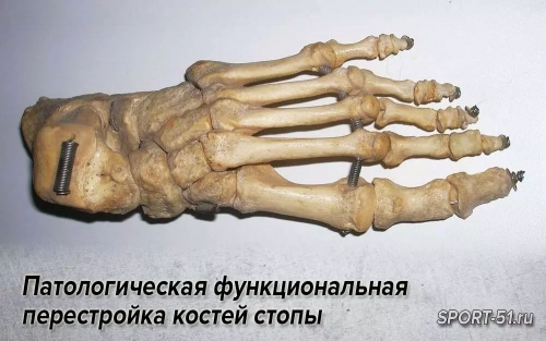 Патологическая функциональная перестройка костей стопы