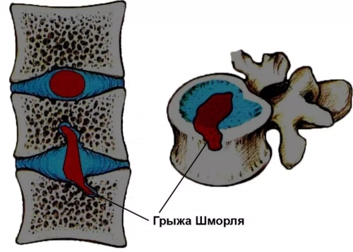 Грыжа Шморля