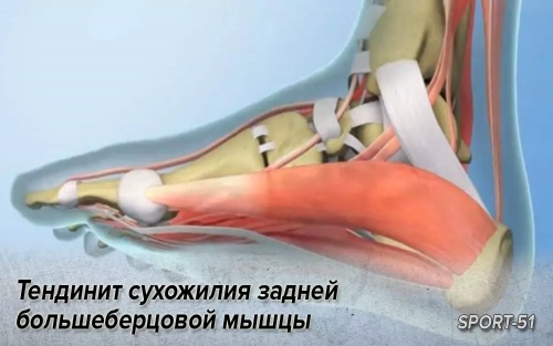 Тендинит сухожилия задней большеберцовой мышцы