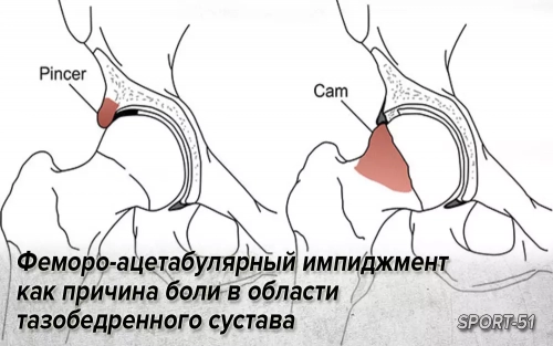 Феморо-ацетабулярный импиджмент как причина боли в облсти тазобедренного сустава