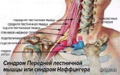 Синдром Передней лестничной мышцы или синдром Наффцигера