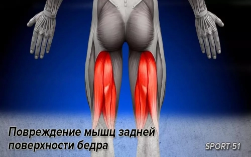 Повреждение мышц задней поверхности бедра