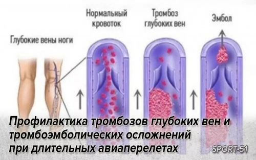 Профилактика тромбозов глубоких вен и тромбоэмболических осложнений при длительных авиаперелетах