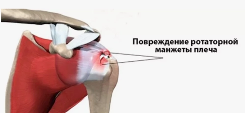 SLAP – синдром плечевого сустава