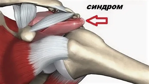 SLAP – синдром плечевого сустава