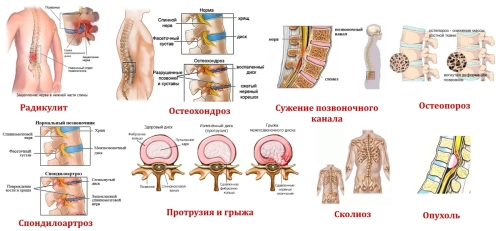 Как полноценно жить и тренироваться с проблемным позвоночником