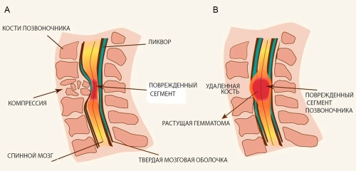 Ушиб спинного мозга